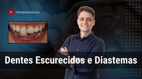 Dentes Escurecidos E Diastemas YouTube