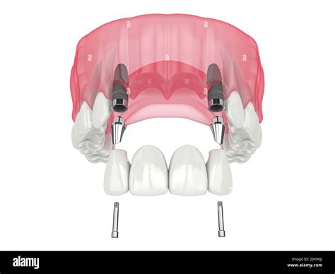 D Render Of Jaw With Dental Incisors Bridge Supported By Implants Over