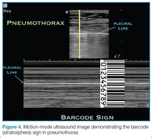 Picture Of Pneumothorax M Mode Ultrasound