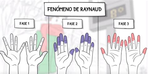 Fenómeno De Raynaud Qué Es Síntomas Y Tratamiento