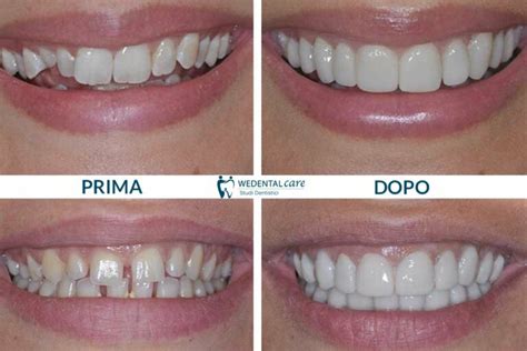 Faccette Estetiche Non Invasive Faccette Dentali Roma Wedental Care