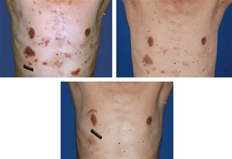 Cutaneous Castleman Disease Munoz 2012 British Journal Of Haematology Wiley Online Library