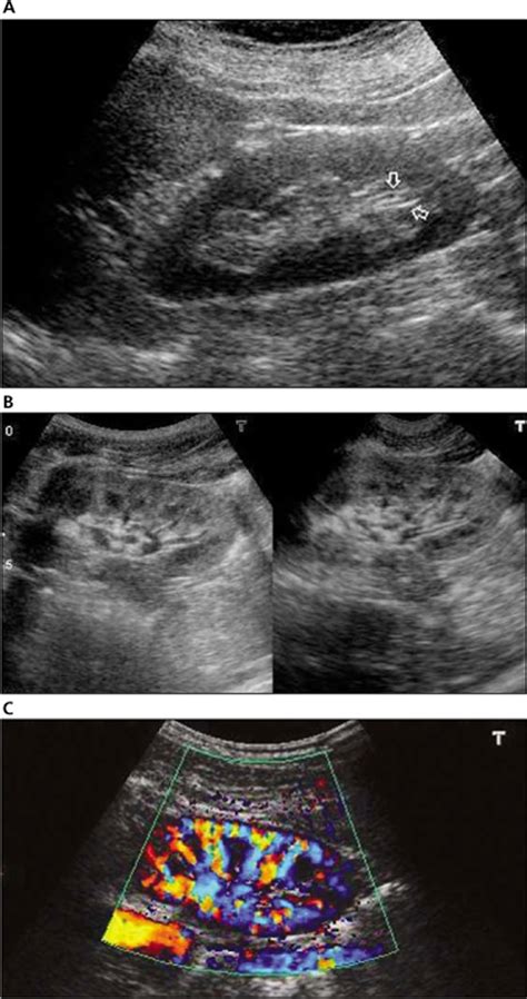 Kidney Stone Ultrasound