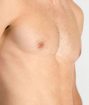 Things You Need To Know About Gynecomastia Aesthetic Surgical Images