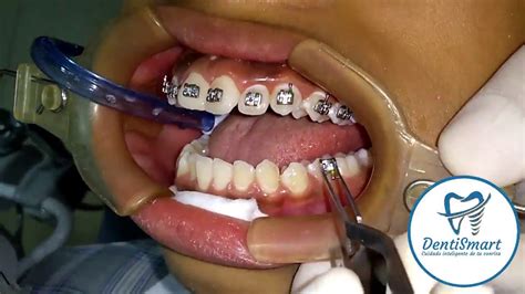 Colocación de brackets YouTube