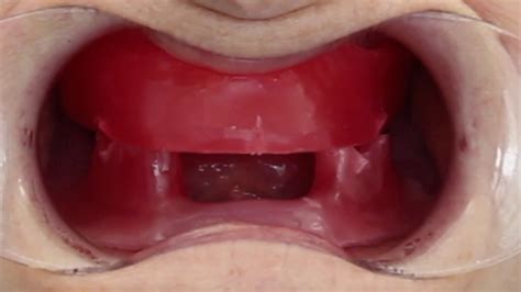 Occlusal Registration For Complete Dentures Demonstrating A