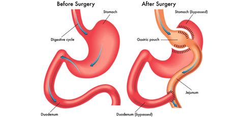 Gastric Bypass Vs Lap Band Clinicexpert