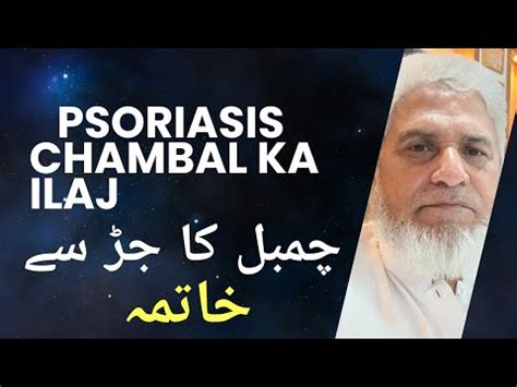 Psoriasis Treatment In Urdu Chambal Ki Bimari Ka Ilaj Psoriasis