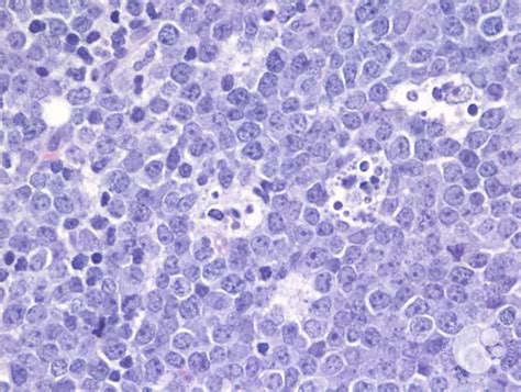 Burkitt Lymphoma Together By St Jude™