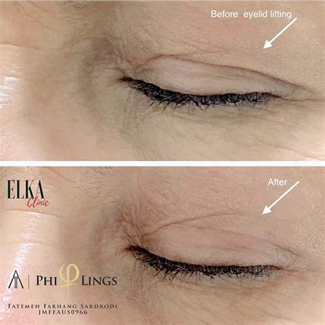 Plasma Pen Non Surgical Eyelid Lift Elka Clinic Blepharoplasty