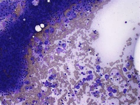 Spleen Fna Hint Plasma Cells And Flame Cells Splenic Extramedullary Plasmacytoma Electron