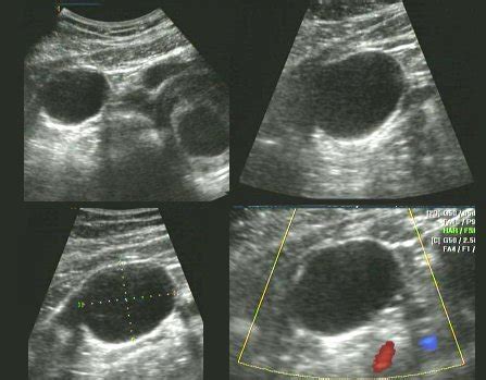 Adnexal Masses in Pregnancy