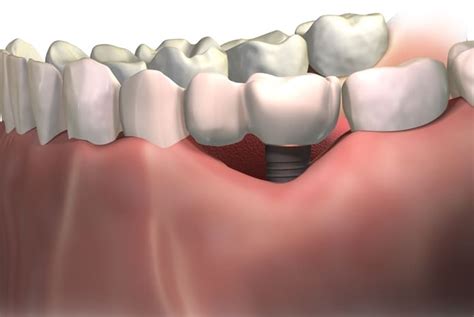 Comparación de la pérdida ósea marginal alrededor de los implantes