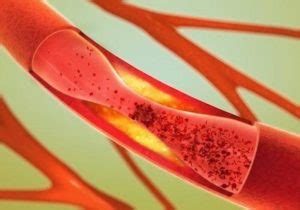 10 Alimenti Che Aiutano A Pulire Le Arterie In Modo Naturale