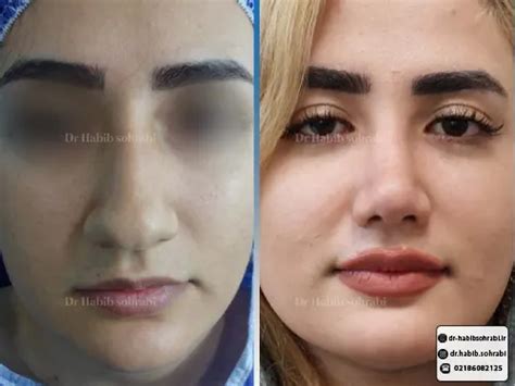 مشاهده عکس‌های قبل و بعد از عمل بینی طبیعی دکتر حبیب سهرابی