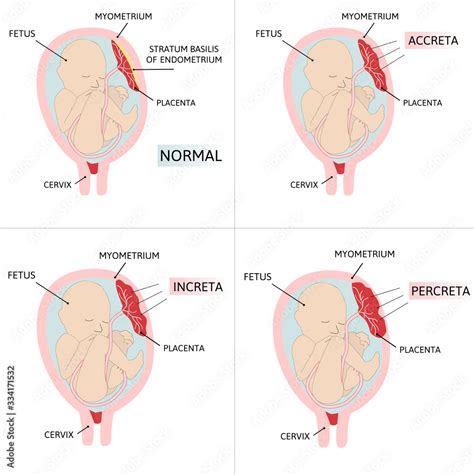 Placenta Accreta Accrete Increta Percreta Colored Medical Stock