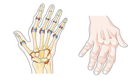 Best Practices To Cope Up With Stages Of Rheumatoid Arthritis