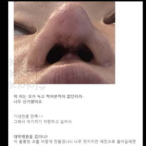 블라인드 블라블라 코 수술 젤 위험하다던데