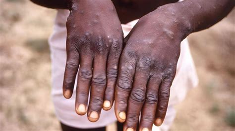 East Sussex New Case Of Clade Ib Mpox Detected Bbc News