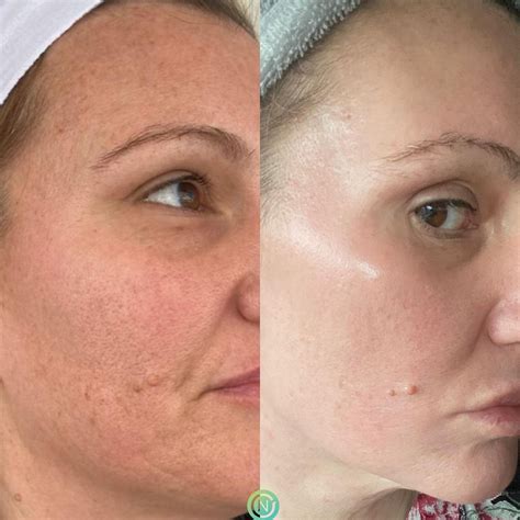 Cosmelan Peel Result01 A Novique Medical Aesthetics