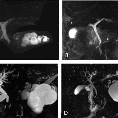 A And B Magnetic Resonance Imaging Scans Showing Presence And Removal