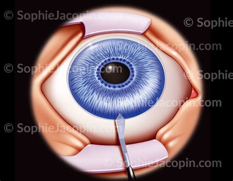 Implant Intraoculaire Incision Illustration Sophie Jacopin