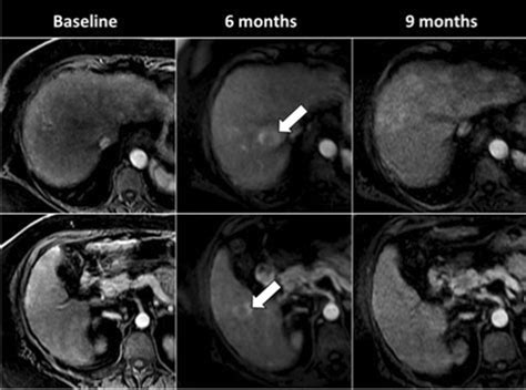 72-year-old woman with NASH cirrhosis. On baseline MRI examination, no... | Download Scientific ...