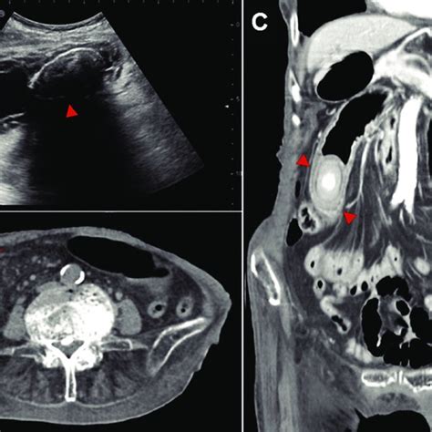 -Diffuse homogeneous fatty infiltration of liver. A, Liver appears... | Download Scientific Diagram