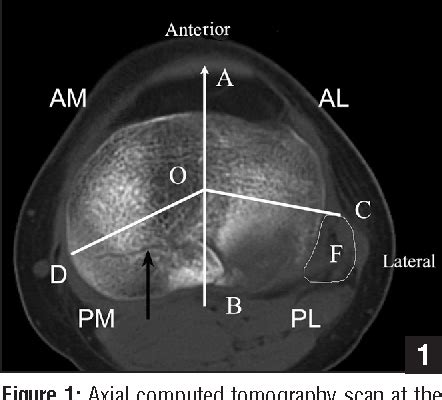 Figure 1 From Morphological Characteristics Of Posterolateral Articular