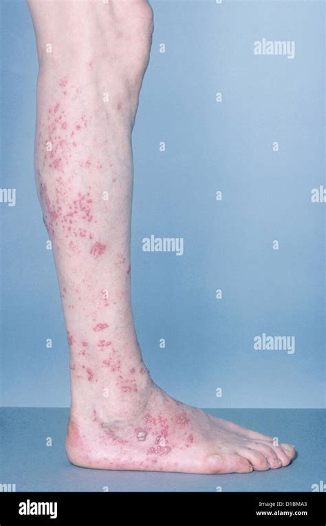 Shingles Leg Dermatome