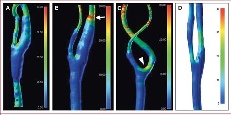 Figure 2 From Computational Fluid Dynamics Of Carotid Arteries After Carotid Endarterectomy Or