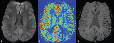 Year Old Girl With Hemiplegic Migraine Presenting With Progressive