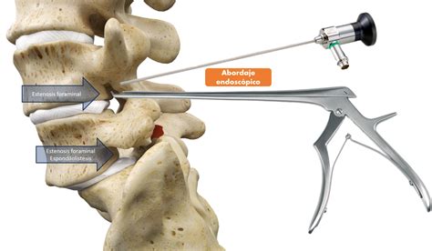 Qu Es La Cirug A Endosc Pica De Columna Dr Mostaza