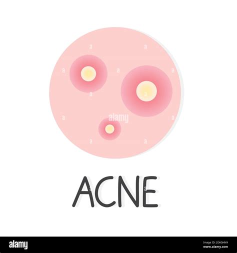 Acne Pimple Concept Vector Illustration Stock Vector Image And Art Alamy