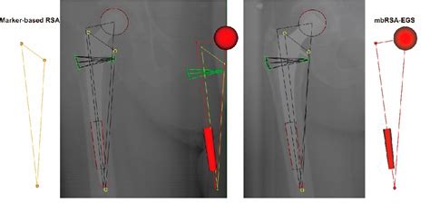 Figure 1 From Model Based Roentgen Stereophotogrammetric Analysis Using