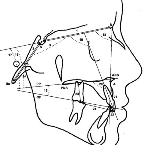 Cephalometric Reference Points Ans Pns Go Gn The Ratio Of The