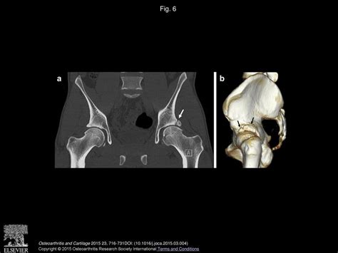 G. E. Gold, F. Cicuttini, M. D. Crema, F. Eckstein, A. Guermazi, R - ppt download