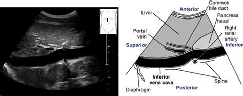 Inferior Vena Cava Ultrasound