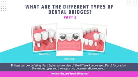 DIFFERENT TYPES OF DENTAL BRIDGES PART 2 CODING MODPractice