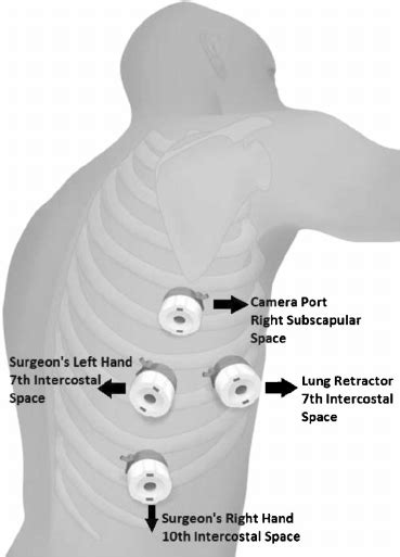 Thoracoscopic Port Placement Download Scientific Diagram