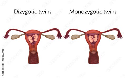 Multiple Pregnancy Dizygotic And Monozygotic Twins Embryo Fetus In Uterus Placenta