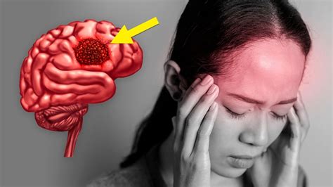 7 Warning Signs Of A Brain Tumor You Should Know YouTube