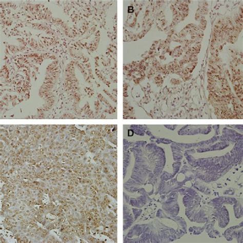 The Chromogenic In Situ Hybridization Results Of Her 2 A And B