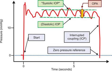 Iop Pachymetry Conversion Chart: A Visual Reference of Charts | Chart ...