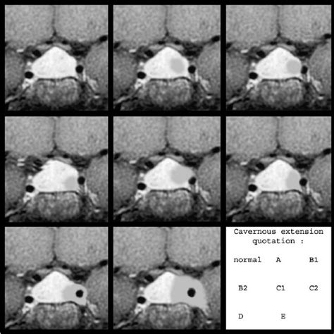 MRI Studies of the Patient's Pituitary Gland MRI of the pituitary gland... | Download Scientific ...