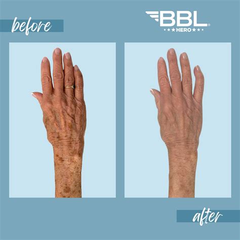 Sciton Bbl Treatment Denver Denver Bbl Laser Treatment