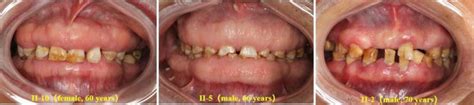 Periodontal Disease Associated With Genetic Disorders Intechopen