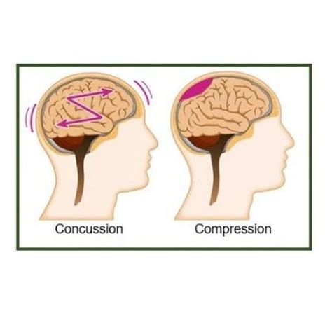 A Simple Diagram Illustrating The Difference Between Concussion Shaking Of The Brain And