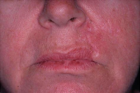 Figure 1 From Revision Of Upper Lip Vermilion Border Elevation