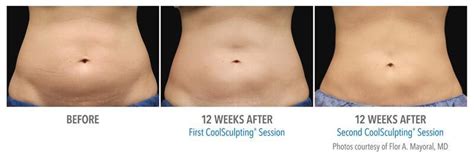 Coolsculpting Glen Town Center Glenview Il Highland Park Il Skin